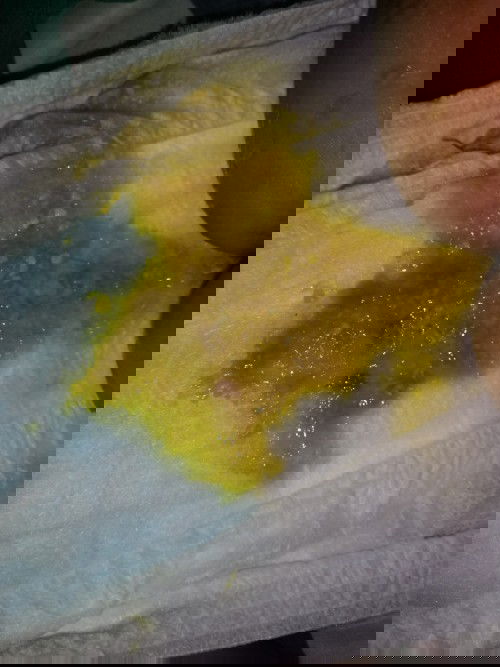 Hi mga mommy, sino po same cases ni baby, is this normal poop for cows milk allergy,