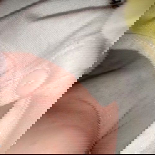 M oi cho em hỏi..cổ con em bị nhu thế này có sao không ạ.. cách trị sao vay cac m