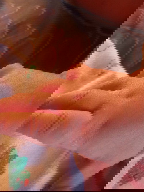 Bintik bintik berair di tangan