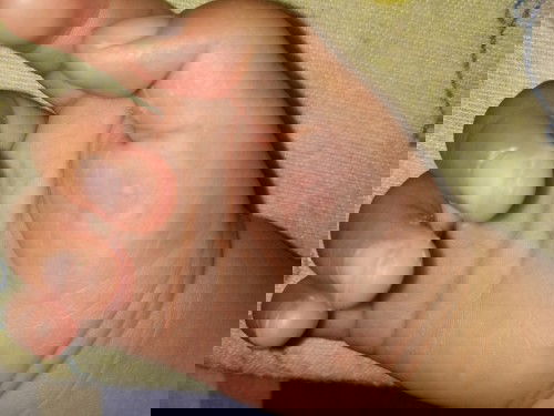 Telapak tangan ganti kulit