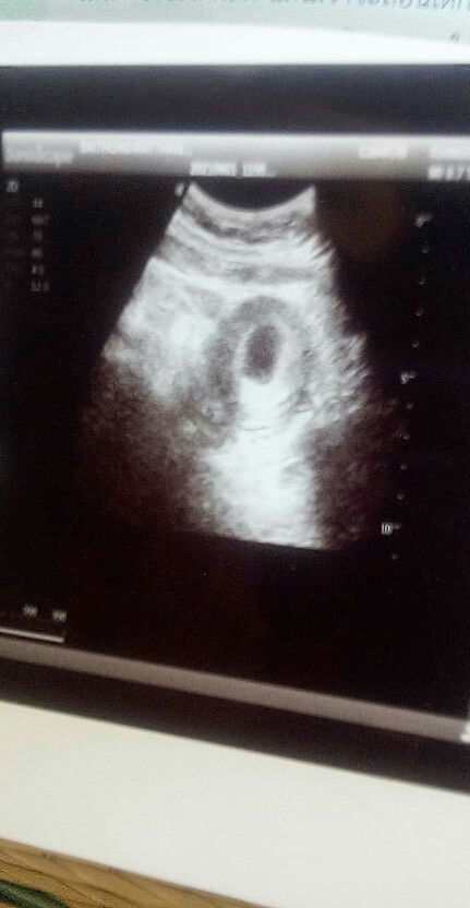 ตอนนี้ครรภ์ได้7สัปดาห์6วันแล้วค่ะแต่หมออัลตร้าซาวด์ไม่พบตัวอ่อนอยู่ในถุงการตั้งครรภ์..!? กังวลมากค่ะ
