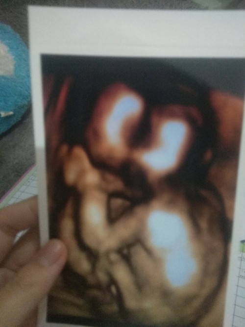hamil15week