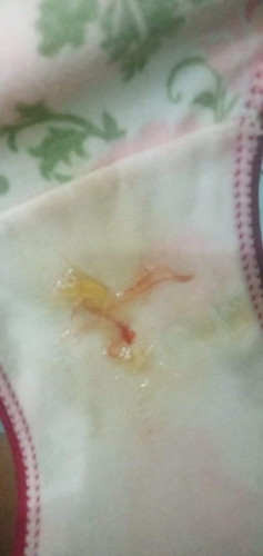 Discharge na may dugo
