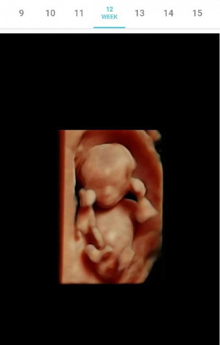 Bakit nawawalan Ng heartbeat ang baby sa loob ng tyan ng mommy??ano po sign pag walang heartbeat??