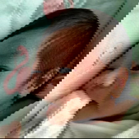 Ano kaya tong tumubo sa mukha ng baby ko? π