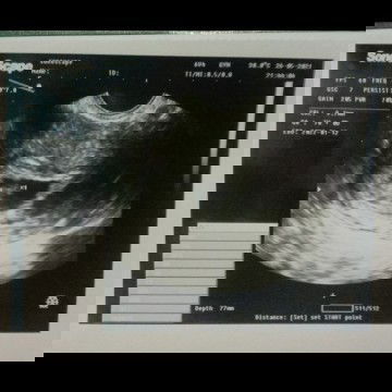 Kantong rahim tidak bulat?