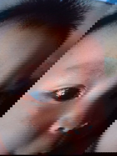 Bruntusan merah dan berair