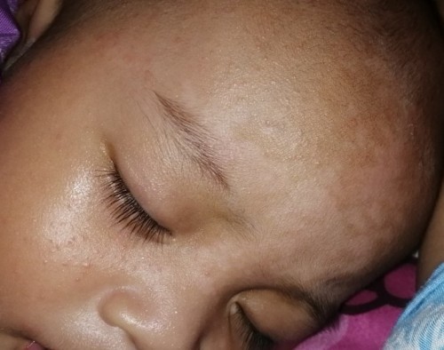 Kulit bercak belang putih kaya panu