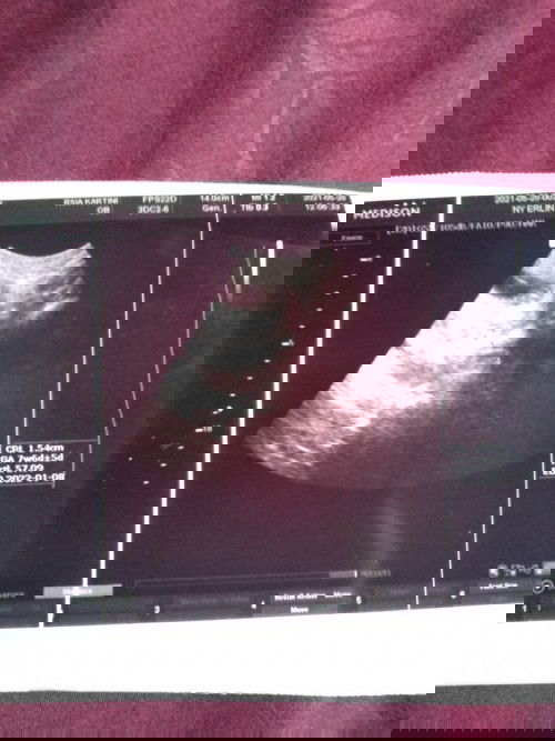 Kram perut bawah setelah melakukan USG