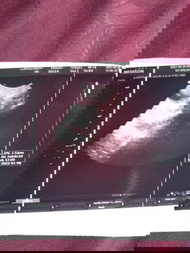 Kram perut bawah setelah melakukan USG