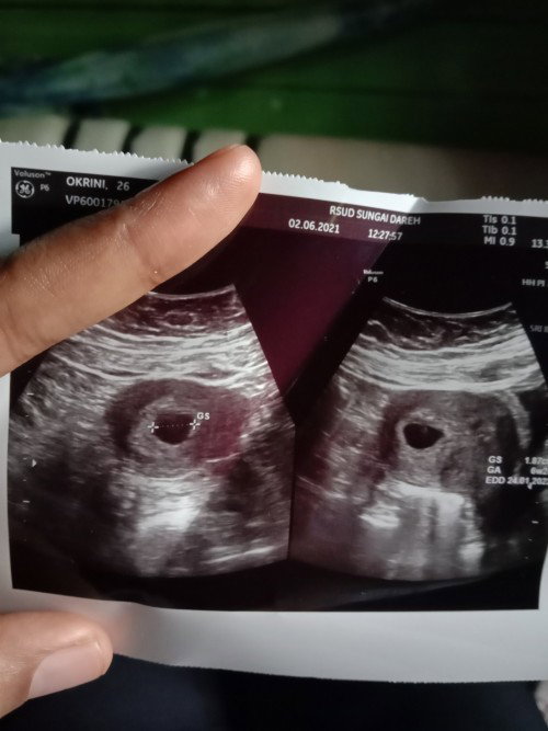 Hasil usg masih berupa kantung