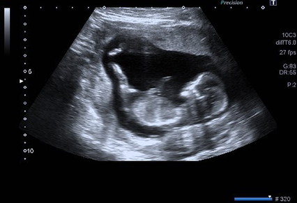 Can tell the gender? Only week 13 ๐