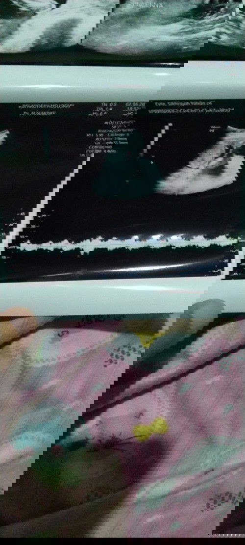 Cara membaca detak jantung di hasil usg