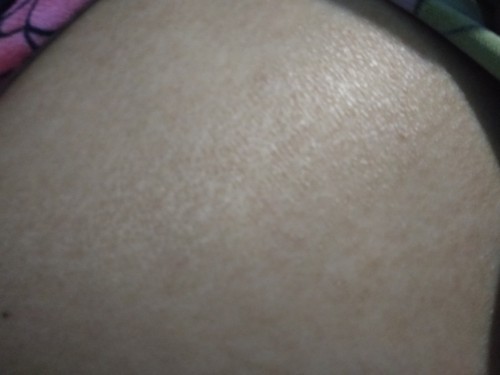 Skin problem