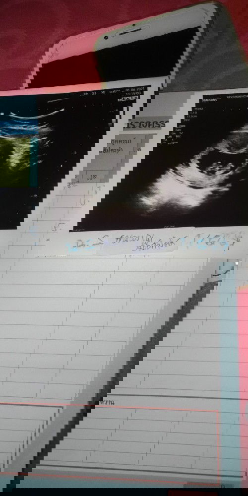 ภาพอัลตร้าซาว10สัปดา