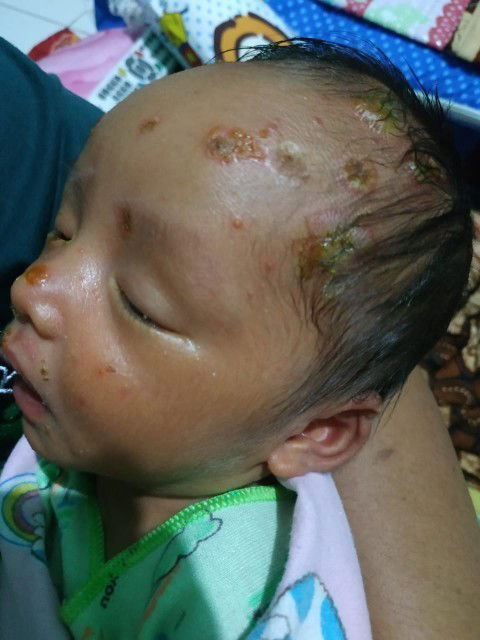 Anak saya keluar kaya cacar tpi kata orang bukan cacar