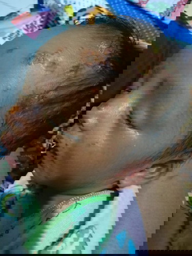 Anak saya keluar kaya cacar tpi kata orang bukan cacar