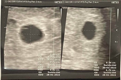 มีคุณแม่ท่านไหนเคยมีประสบการณ์เลือดออกตอนตั้งครรภ์ ช่วง 5-7 วีคบ้างค่ะ