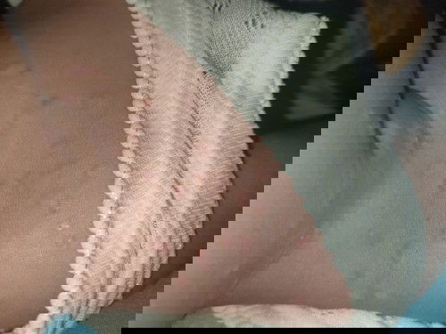 Gatal Gatal Merambat