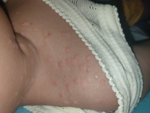 Gatal Gatal Merambat