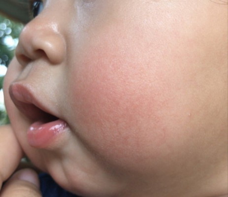 SebAb pipi bayi merah dan kering