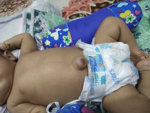 pusat baby terkeluar siapa ibu bapa yg pernah mengalami?