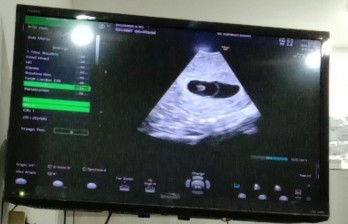 Adakah yang usia kehamilan 9 minggu tapi janin masih belum terlihat saat usg bun?