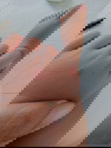 สอบถามรอยแดง