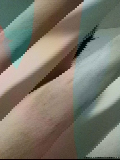 ผื่นแดงๆคันมากๆ