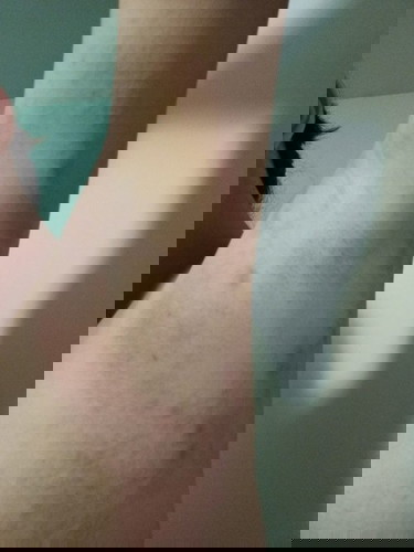 ผื่นแดงๆคันมากๆ