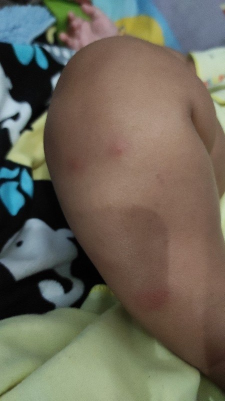 Gejala herpes atau tidak