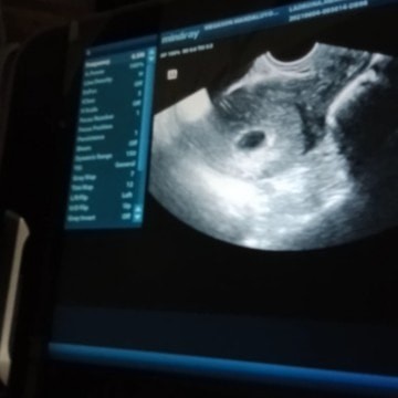 Nagpacheck up po ako sa center sabi 5weeks na daw ako buntis pero nung nagpa tvs ultrasound po ako