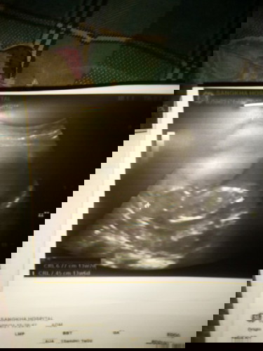 13สัปดาห์4วันน้องยังสร้างแขนขายังไม่ควบกังวลค่ะ