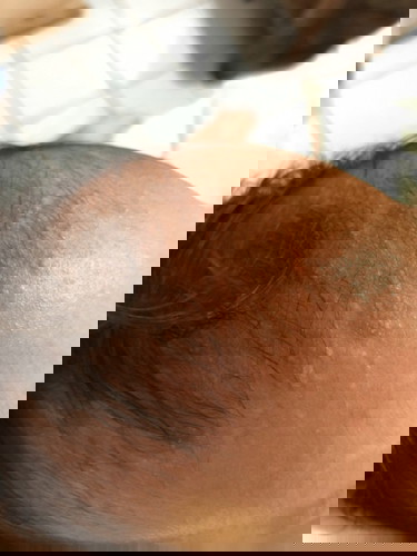 Baby Acne