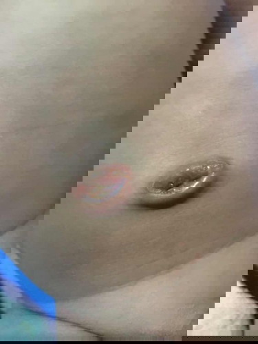 สดือแบบนี้แปลว่าอักเสบใช่ไมคะ
ขอสอบถามแม่ๆหน่อยค่ะ
ท้องแรกค่ะ