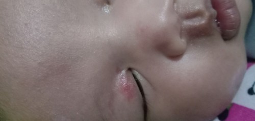 Merah Di Kelopak Mata