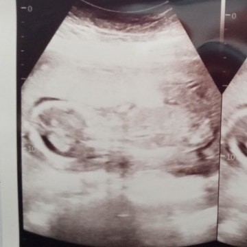 Posisi Bayi Telentang (18Week)