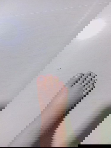 เท้าบวม 36+5