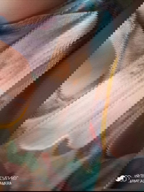 Preterm Labour at 28weeks