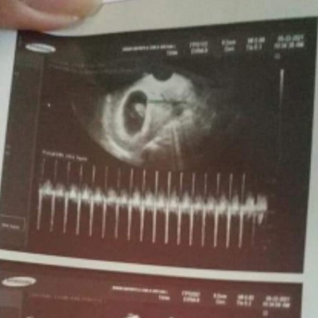 Hi po 10weeks preggy. Normal ba na sumasakit yung puson ko twing gabi? 3/10 sakit no discharge