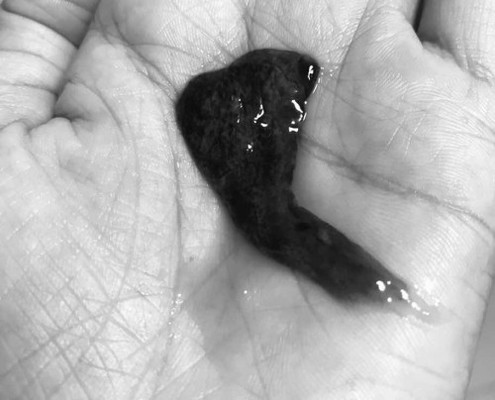 คืออะไรคะแท้งหรอคะแบบนี้