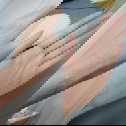 มีอาการมือบวมค่ะ