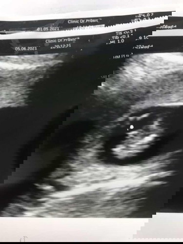 รู้เพศลูก ผลอัลตราซาวด์