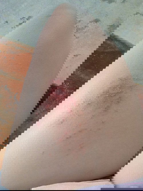 ผื่นแบบนี้ สอบถามผู้รุ้ค่ะ