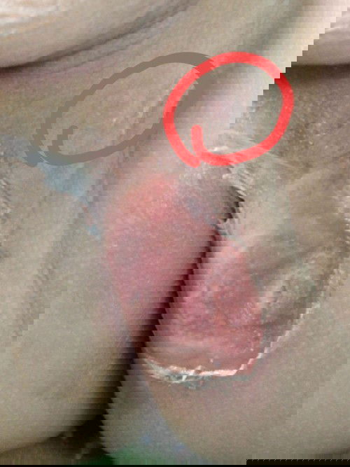 แม่ๆบ้านไหนลูกเคยเป็นแบบเราบ้างค่ะ ขอคำแนะนำหน่อยค่ะ