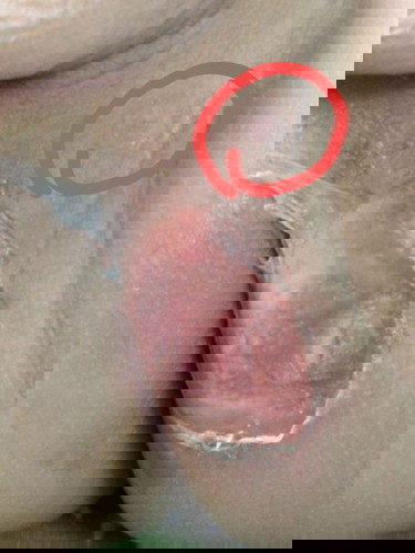 แม่ๆบ้านไหนลูกเคยเป็นแบบเราบ้างค่ะ ขอคำแนะนำหน่อยค่ะ