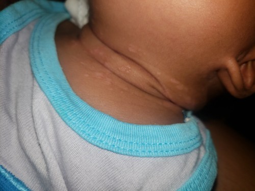 Rashes ni baby