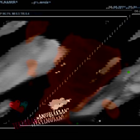 janin lancip di perut di usg ternyata cewe