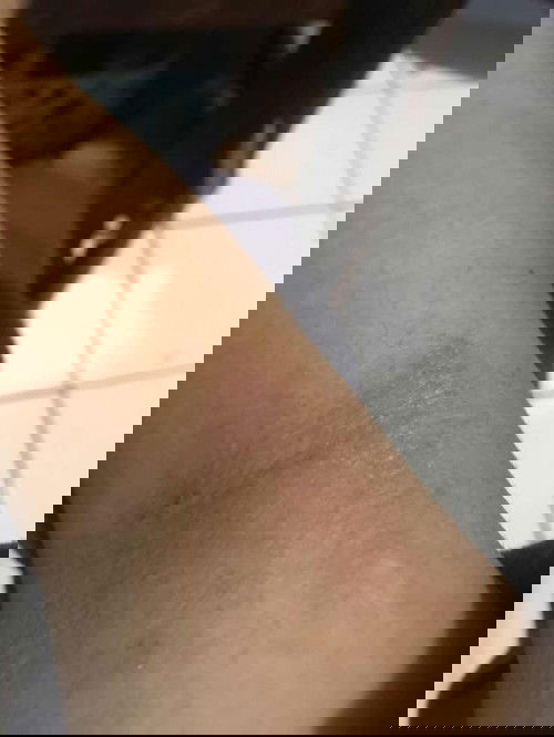 Semenjak hamil eksim