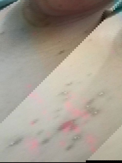 Jerawat atau apa yah bun???